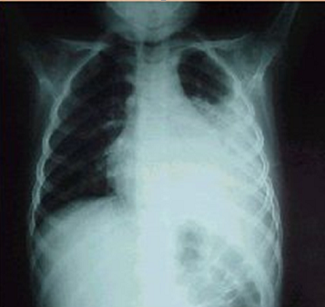 Causas de la neumonía: hongos, virus y bacterias